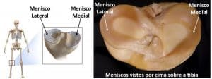 Menisco Lateral e Medial visto por cima sobre a tíbia