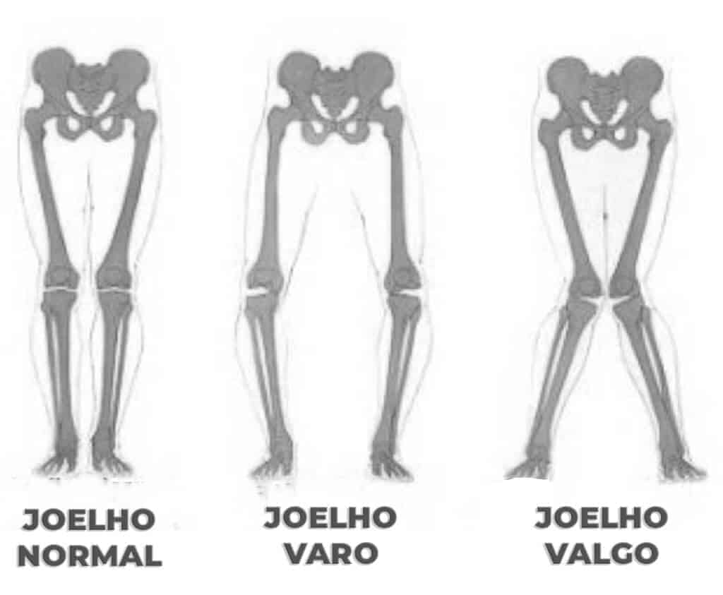 Osteotomia com joelho normal, vago e varo