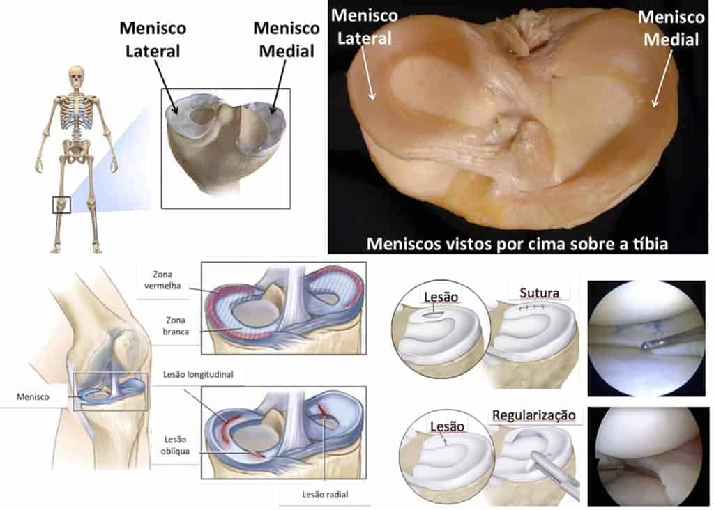 Lesão, Sutura e Regularização do Menisco Lateral e Menisco Medial