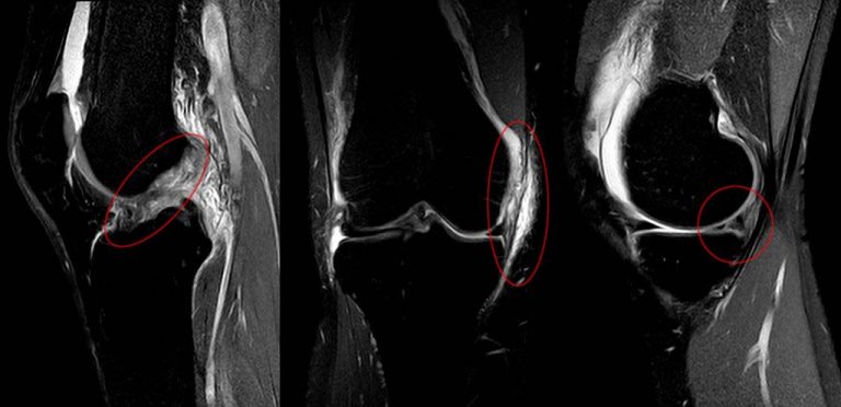 A ressonância magnética é o exame mais importante para avaliar a lesão do LCA pois fornece dados não só do grau de comprometimento do ligamento como também de lesões associadas de outras estruturas a exemplo dos meniscos e da cartilagem, muito frequentes na lesão do LCA.