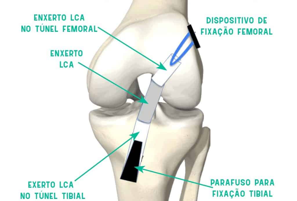 Ligamento Cruzado Anterior Rompido sendo corrigido por Enxerto LCA no túnel femoral e tibial por meio de um dispositivo de fixação femoral e tibial