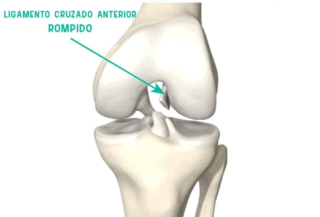 Ligamento cruzando anterior sendo rompido