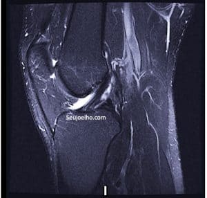 Ressonancia magnetica mostrando ligamento cruzado anterior normal do joelho 