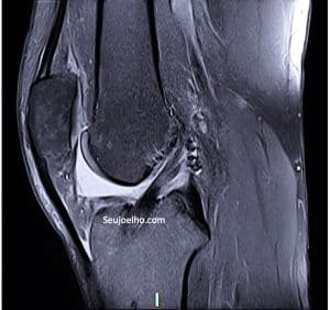 Ressonancia magnetica mostrando ligamento cruzado anterior do joelho reconstruido de maneira anatomica 