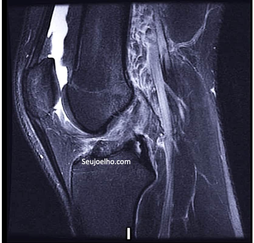 Ressonancia magnetica mostrando ligamento cruzado anterior do joelho reconstruido de maneira anatomica